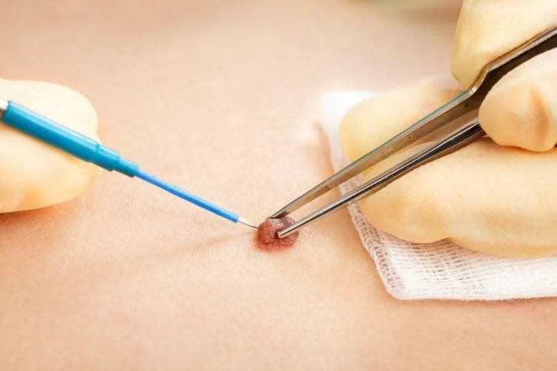 best-wart-removal-in-jabalpur