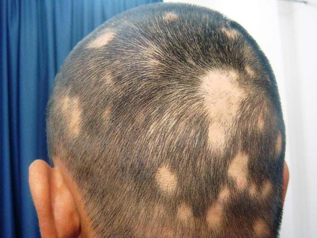 alopecia-areata-treatment.jpeg