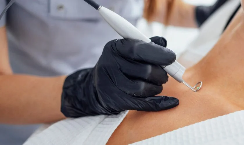 best-wart-removal-in-bhopal