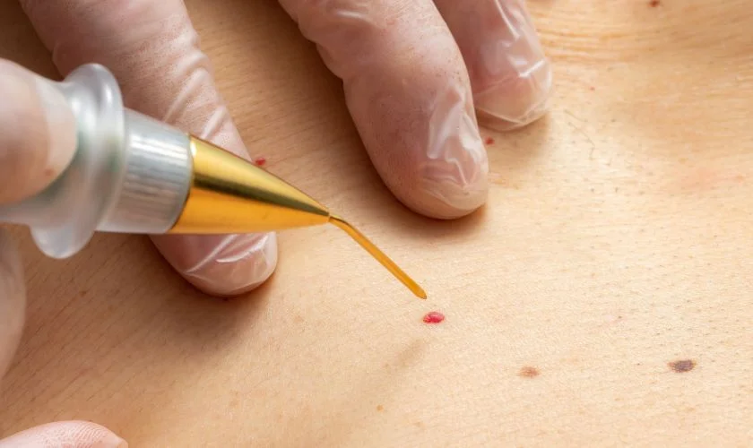 best-wart-removal-in-indore